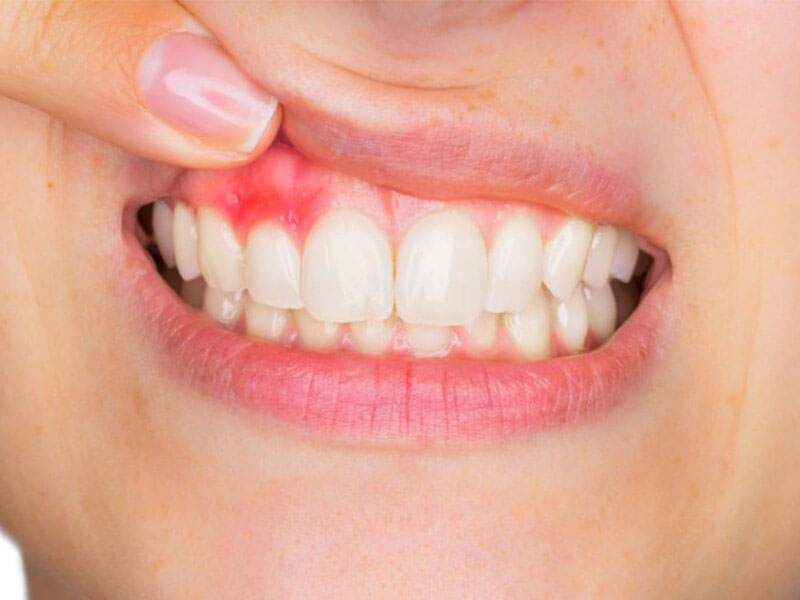 Diş Eti Hastalıkları Tedavileri